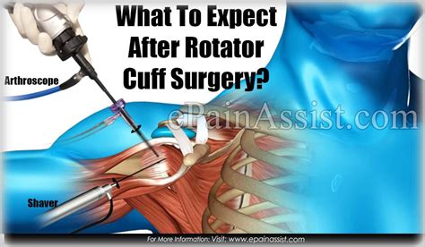 what to expect after rotator cuff surgery